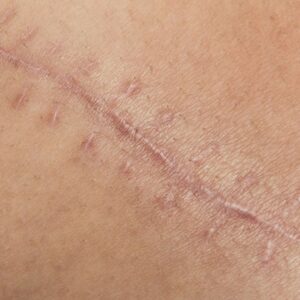 Inflamação e Reparo Tecidual